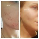 Отзывы о La Roche-Posay Effaclar Ультра концентрированная сыворотка